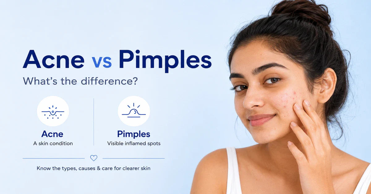 Acne and Pimples